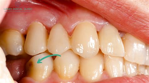 cavity goon|what does a cavity look like.